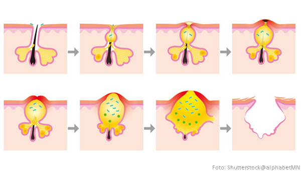 Pickel Unter Der Haut : Pickel Unter Der Haut Was Kann Man Tun Doktor Haut De / Sicherlich kennst du bereits die ursachen für eine normale entzündung, doch verstopfen die.